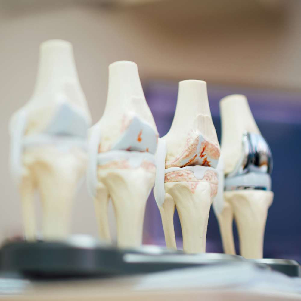 Model of a knee joint with metal components on a blurred background